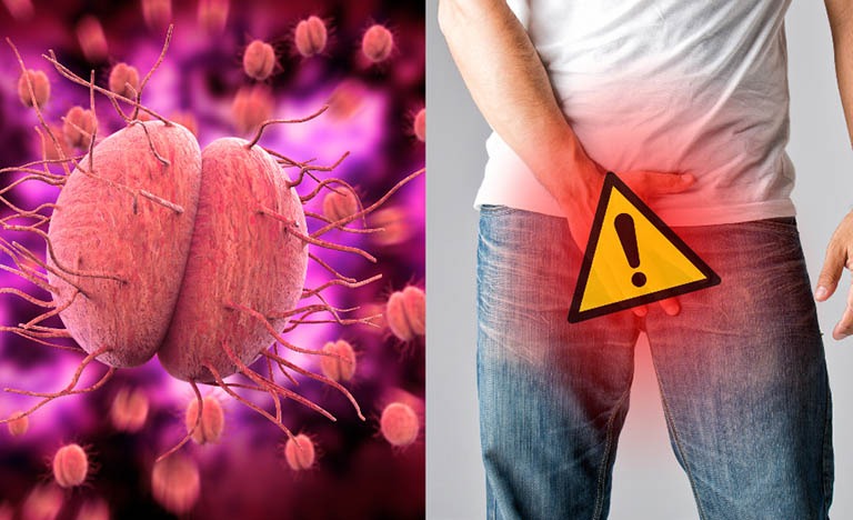 Bệnh lậu có tái phát không? Phòng nguy cơ tái phát bệnh lậu1