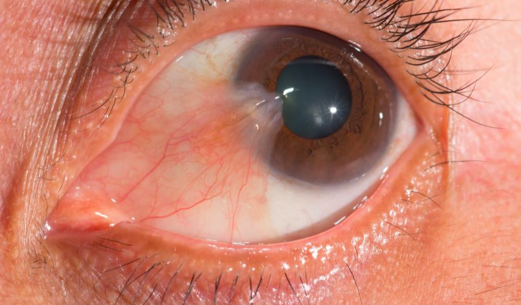 Bệnh mộng thịt ở mắt là gì? Có điều trị được không? 1