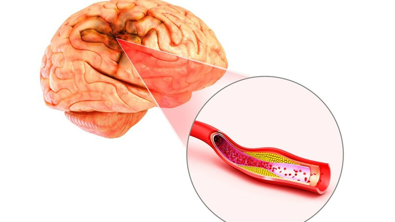 benh-nen-lam-tang-nguy-co-dot-quy-la-nhung-benh-nao 4