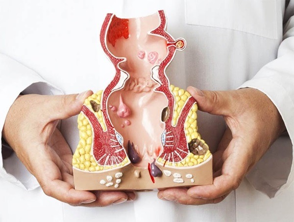 Bệnh nhân cắt trĩ bao lâu thì hết dịch? Chăm sóc sau mổ trĩ để nhanh hết dịch