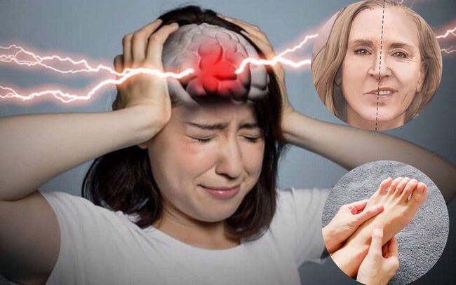 Bệnh nhồi máu não có nguy hiểm không? 2