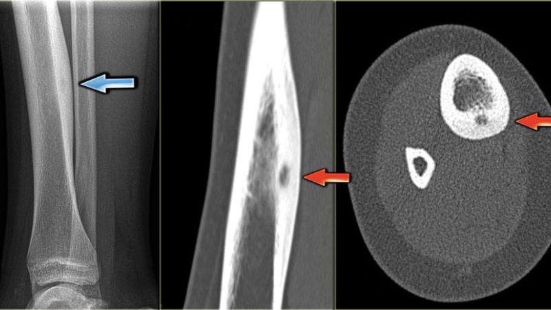 Bệnh osteoma là gì và cách điều trị như thế nào? 1