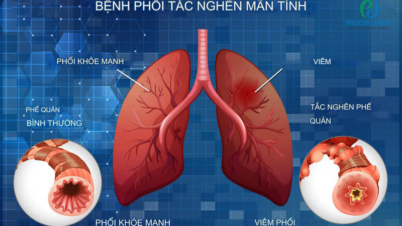 Cách đọc kết quả đo chức năng hô hấp: Hướng dẫn chi tiết 4
