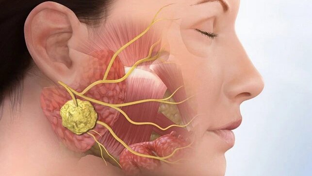 Bệnh quai bị có nổi hạch không? 1