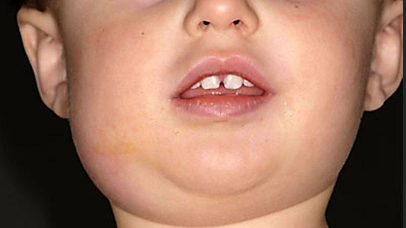 Bệnh quai bị ở trẻ em cần kiêng gì, kiêng trong bao lâu? 5