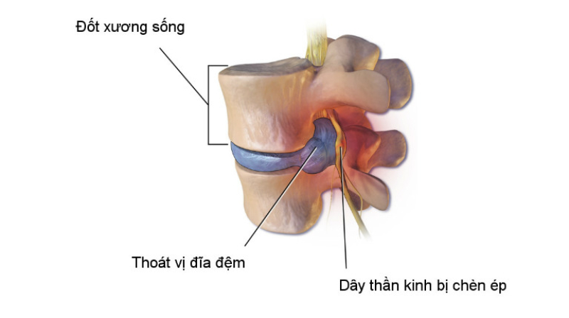 Bệnh rễ thần kinh thắt lưng: Nguyên nhân, triệu chứng và cách khắc phục 3