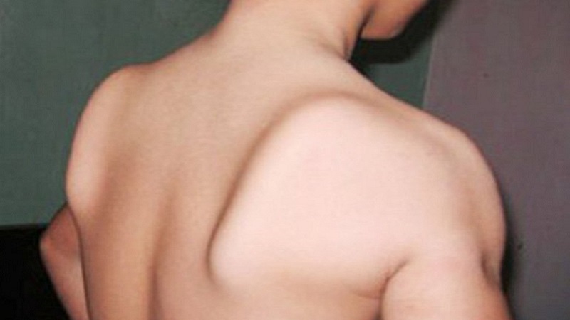 Bệnh teo cơ delta: Dấu hiệu, nguyên nhân và giải pháp can thiệp 3