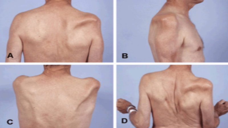 Bệnh teo cơ delta: Dấu hiệu, nguyên nhân và giải pháp can thiệp 5