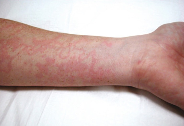 Bệnh thấp tim là gì? Bệnh thấp tim nguy hiểm như thế nào?3