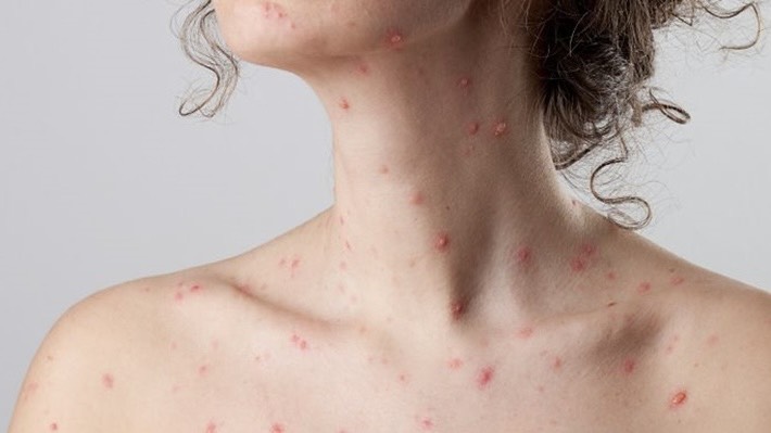 benh-thuy-dau-nang-nam-biet-dau-hieu-bien-chung-va-cach-phong-ngua 1