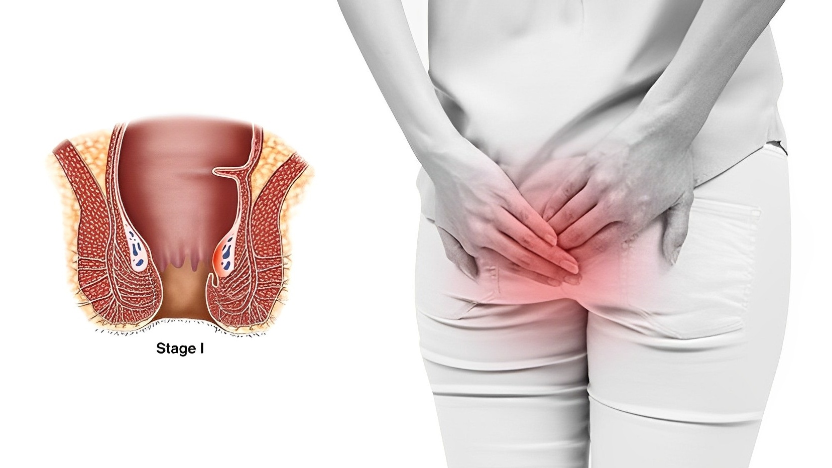 Dấu hiệu bệnh trĩ giai đoạn đầu? Có thể tự khỏi được không?