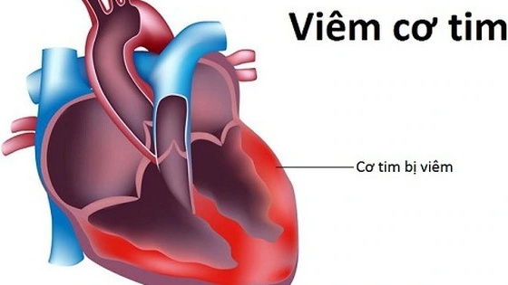 Bệnh viêm cơ tim cấp nguy hiểm thế nào? 1