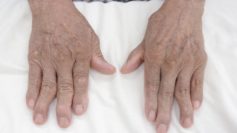 benh-viem-da-khop-co-chua-duoc-khong-nhung-dieu-can-biet 2