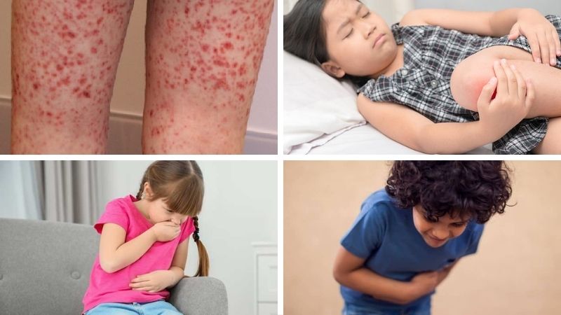 Bệnh viêm mạch do IgA là gì? Có nguy hiểm không? 2