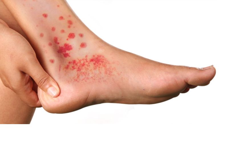 Bệnh viêm mạch xuất huyết Schonlein Henoch có nguy hiểm không? 2