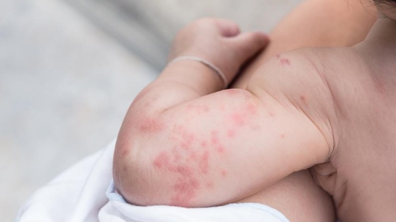 Bệnh zona ở trẻ em có nguy hiểm không? 2