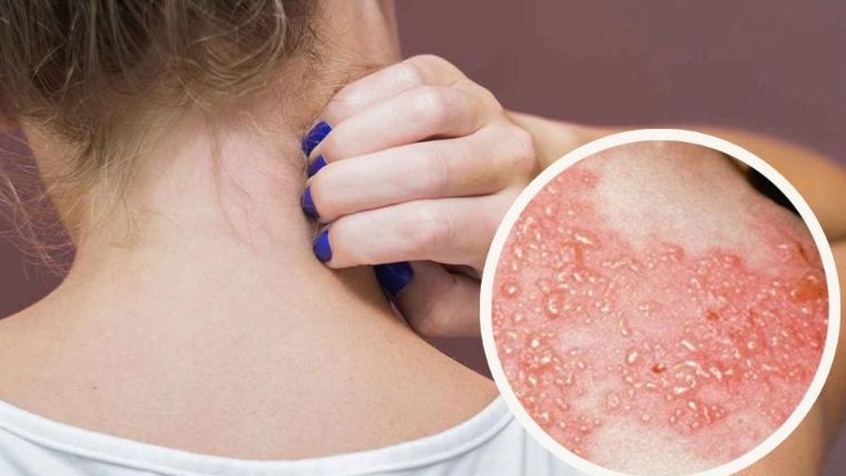 Bệnh zona thần kinh kiêng nước không? 1