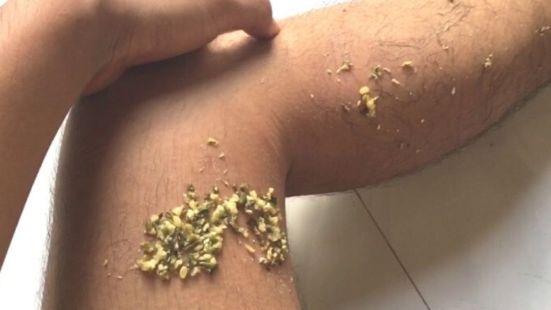 Bệnh zona thần kinh kiêng nước không? 3