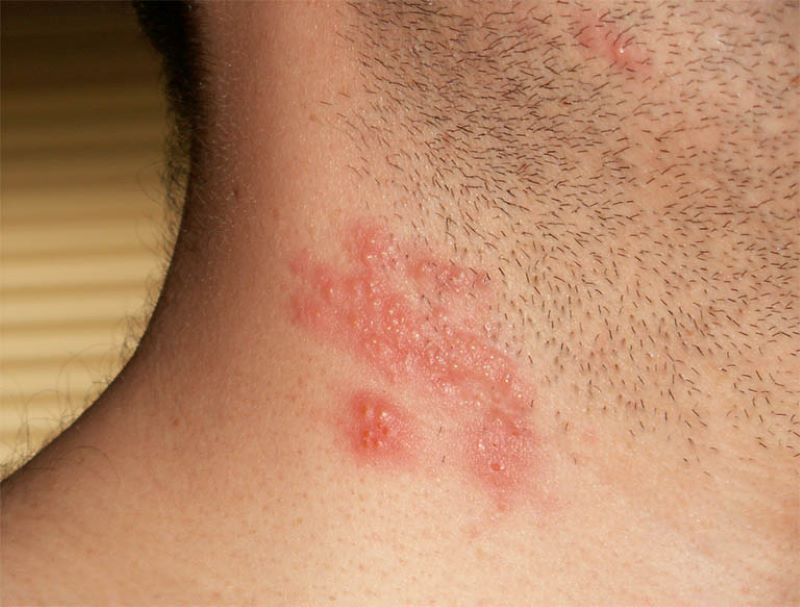 Bệnh zona thần kinh ở cổ là gì? Những thông tin cần biết 2