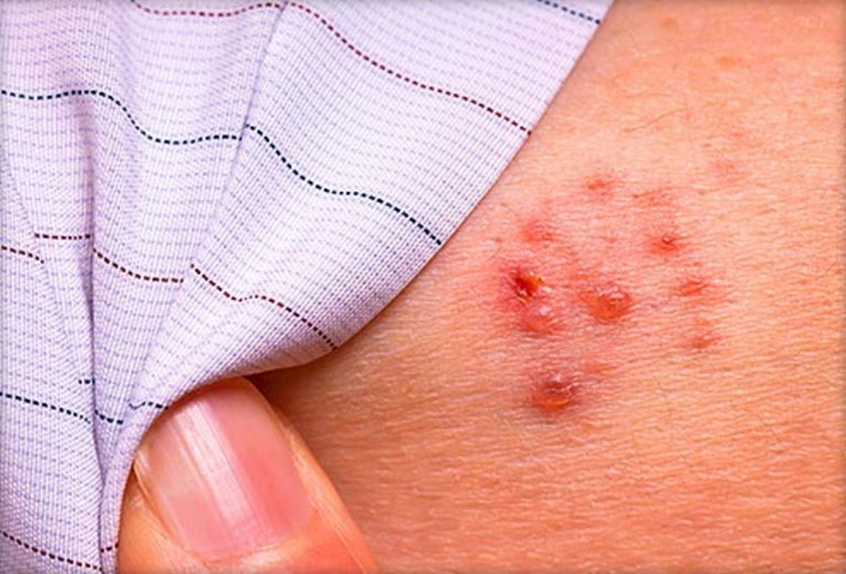 Bệnh zona thần kinh và Herpes khác nhau như thế nào?1