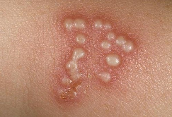 Bệnh zona thần kinh và Herpes khác nhau như thế nào? 2