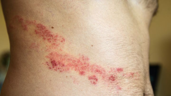 Bệnh zona thần kinh và Herpes khác nhau như thế nào? 3