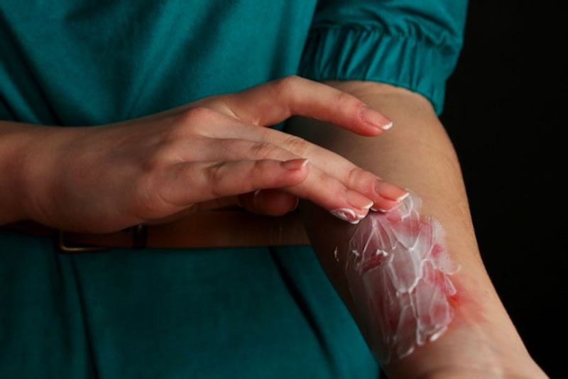 Bị bỏng nước sôi bôi thuốc gì nhanh hết? 3