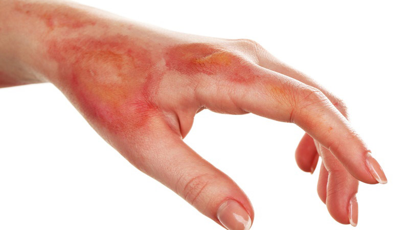 Bị bỏng nước sôi bôi thuốc gì nhanh hết? 1