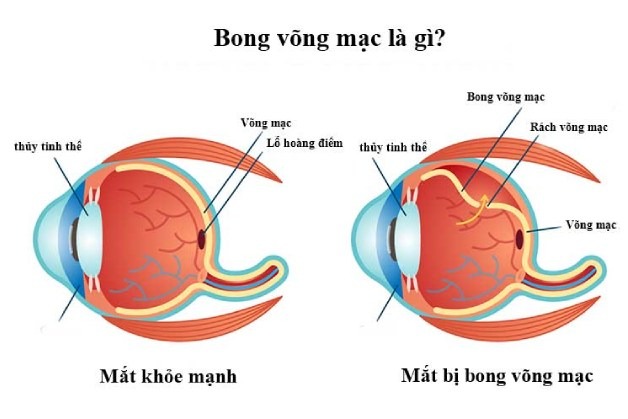 Bị bong võng mạc mắt trái có nguy hiểm không? 1