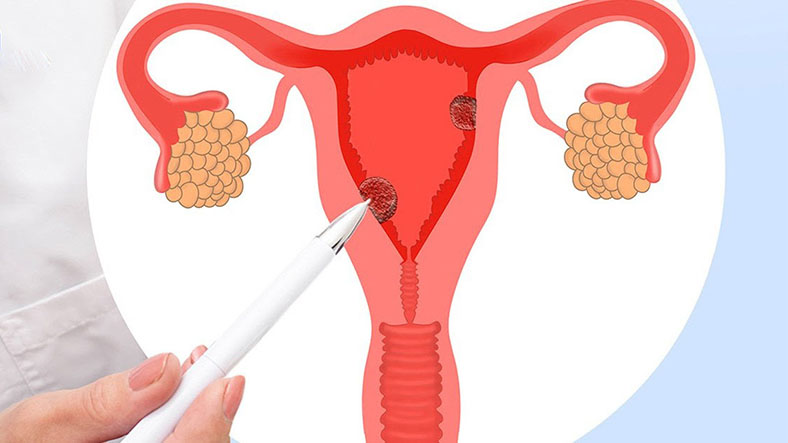 Bị buồng trứng đa nang có tự khỏi không? 1