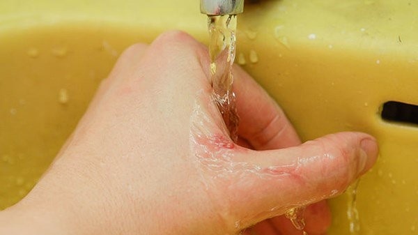 bi-cho-can-lan-2-co-can-chich-ngua-khong-nhung-dieu-can-biet 4