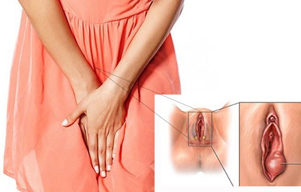 Bị đau một bên mép vùng kín do nhiễm trùng nấm men gây sưng môi âm đạo