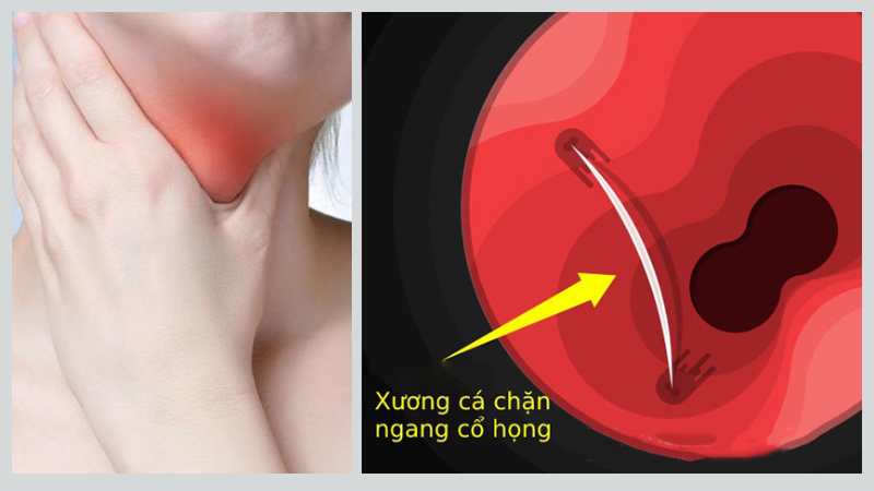 Bị hóc xương cá lâu ngày có đáng ngại không? 4