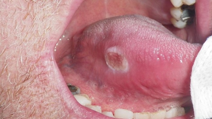 Bị loét ở lưỡi không thấy đau có phải dấu hiệu ung thư lưỡi? 5