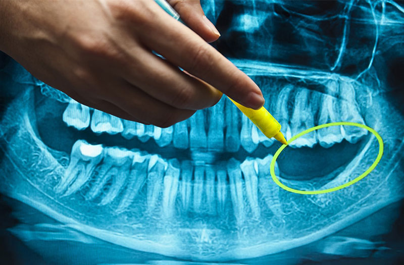 Bị mất răng toàn hàm phải làm thế nào để khắc phục?2