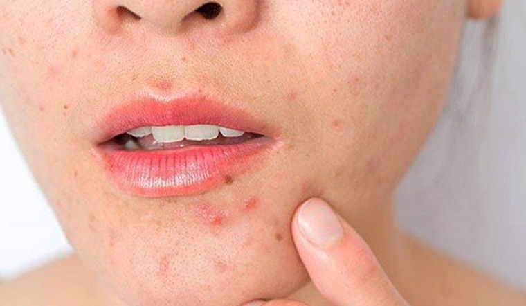 Bí quyết chăm sóc làn da dầu mùa hanh khô 2