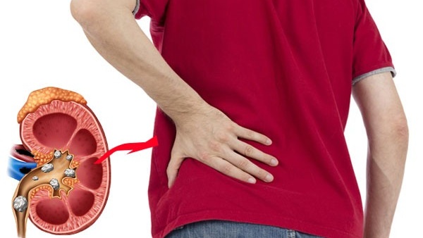 Bị sỏi thận nên ăn gì? Xây dựng thực đơn dinh dưỡng