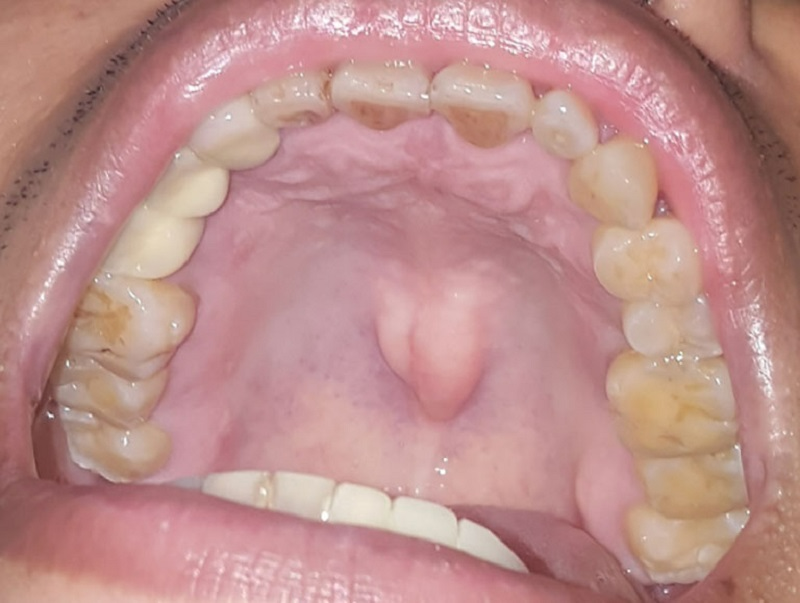 Bị sưng vòm miệng trên có đáng lo ngại hay không?1