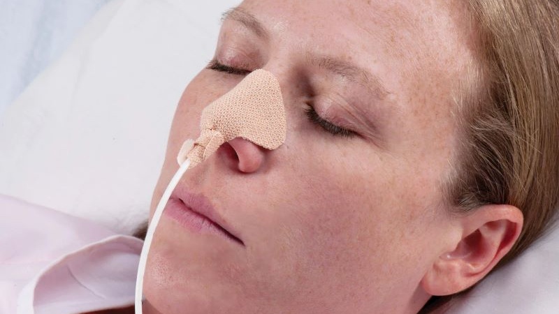 Biến chứng đặt sonde dạ dày mà bạn 1 cần biết