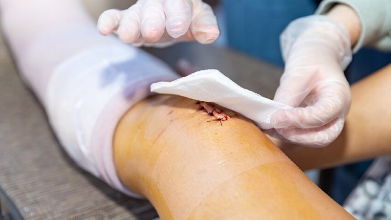 Biến chứng sau phẫu thuật gãy xương: Dấu hiệu và cách ngăn ngừa 3