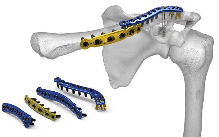 Biến chứng sau phẫu thuật gãy xương và cách phòng ngừa 1