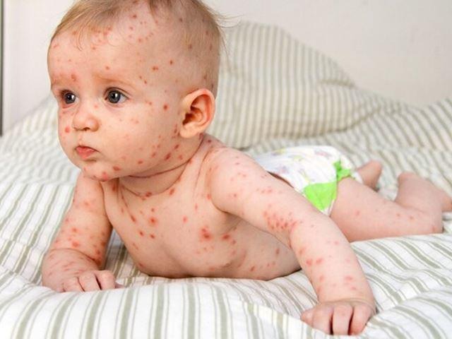 Biến chứng sởi ở trẻ em nhanh và nguy hiểm như thế nào? 2