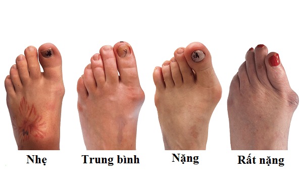 Biến dạng ngón chân cái là do đâu? Cách xử lý như thế nào? 1