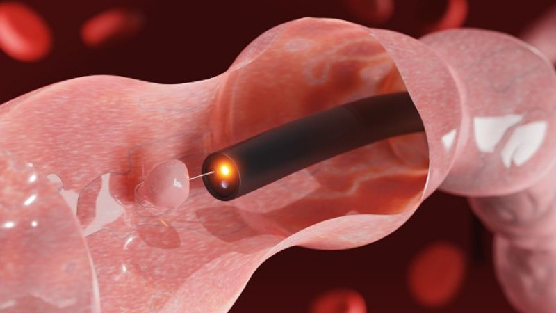 Biểu hiện của ung thư trực tràng và cách phòng ngừa 3