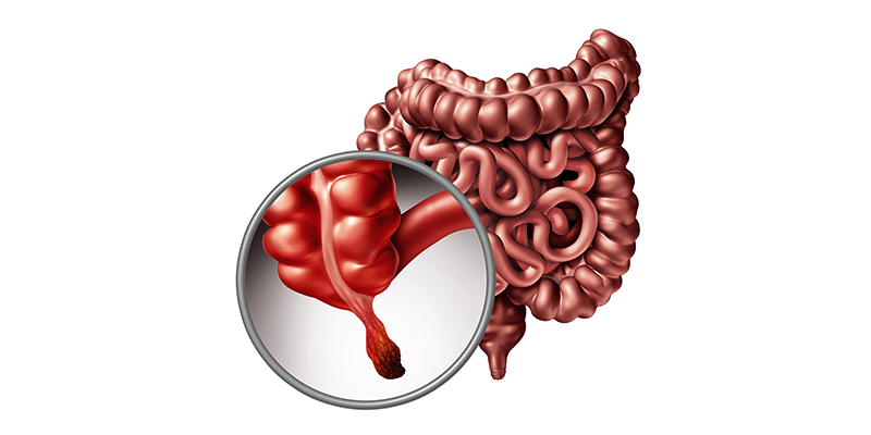 Biểu hiện đau ruột thừa nữ: Nhận biết sớm để điều trị kịp thời 1