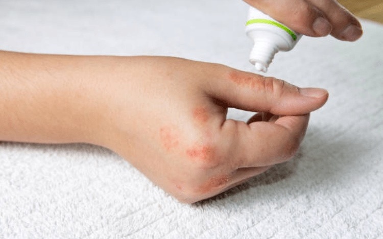 Biểu hiện viêm da tiếp xúc do kiến ba khoang và cách xử lý 3