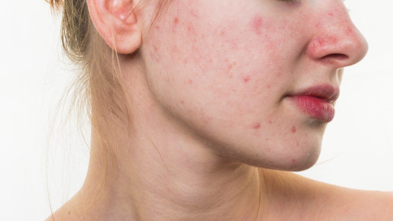 Bisabolol là gì? Công dụng tuyệt vời trong chăm sóc da của Bisabolol 4