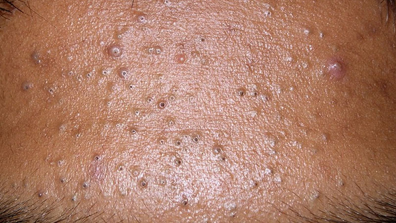 Bít tắc lỗ chân lông: Nguyên nhân và cách xử lý 1