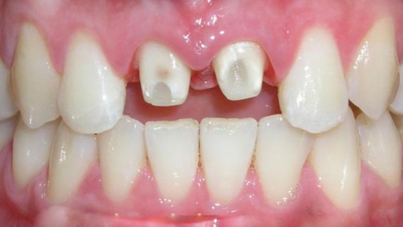 Bọc răng sứ có đau không? Nguyên nhân gây đau 2