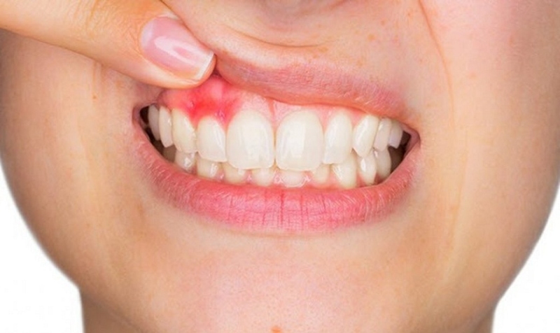 Bọc răng sứ có gây đau đớn không? Những cảm giác sau khi bọc răng sứ cần lưu ý là gì? 4